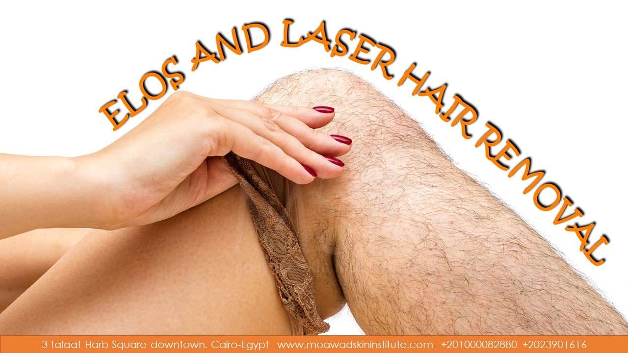 ELOS AND LASER HAIR REMOVAL FEMALE