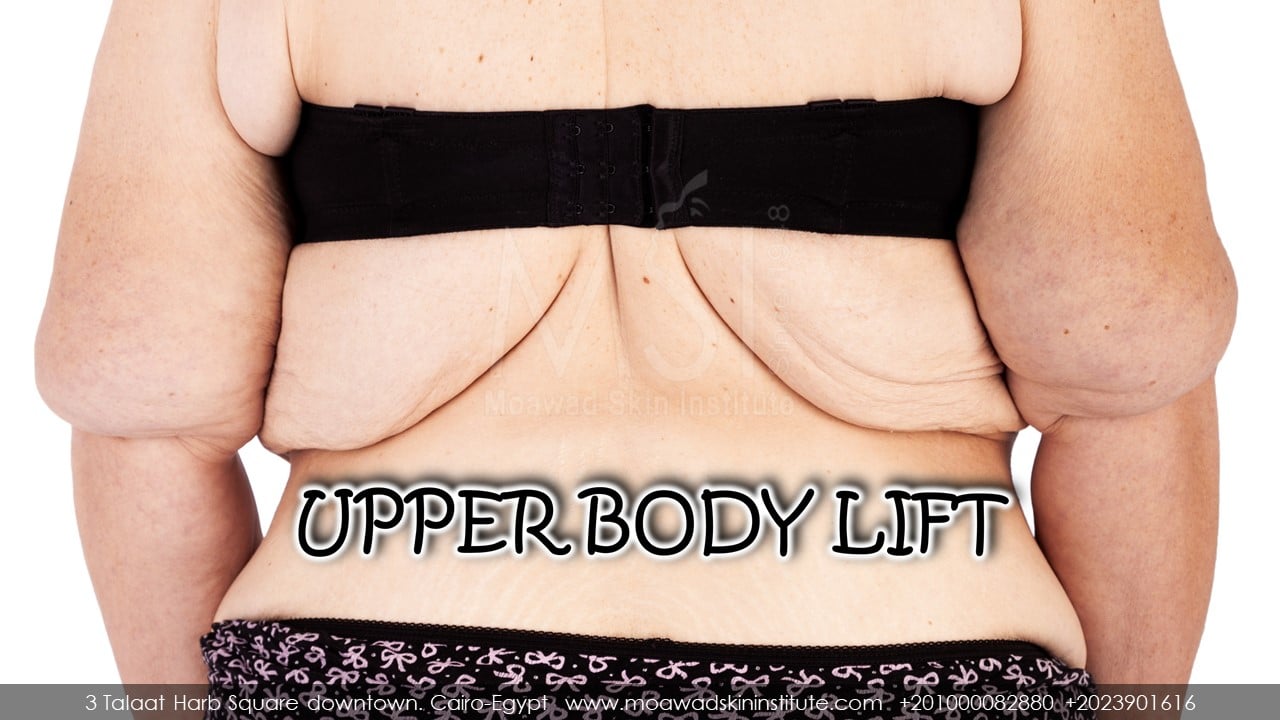 UPPER BODY LIFT