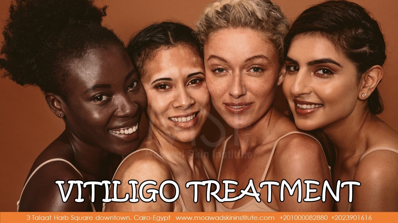 VITILIGO TREATMENT GROUP