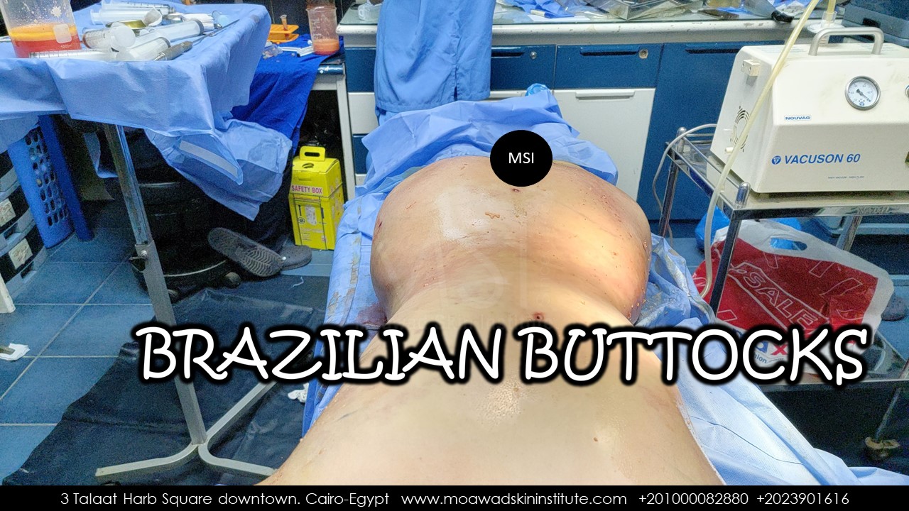 BRAZILIAN BUTTOCKS.IMMEDIATE
