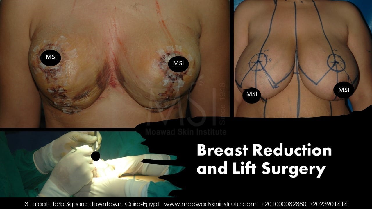 BREAST REDUCTION AND LIFT SURGERY-BA