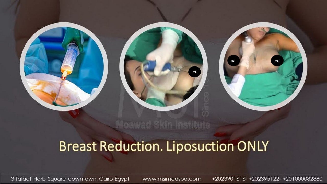 BREAST REDUCTION. LIPOSUCTION ONLY
