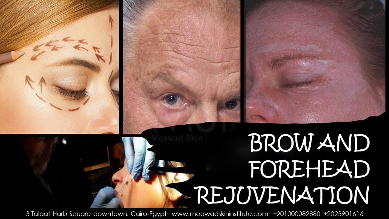 BROW AND FOREHEAD REJUVENATION_2