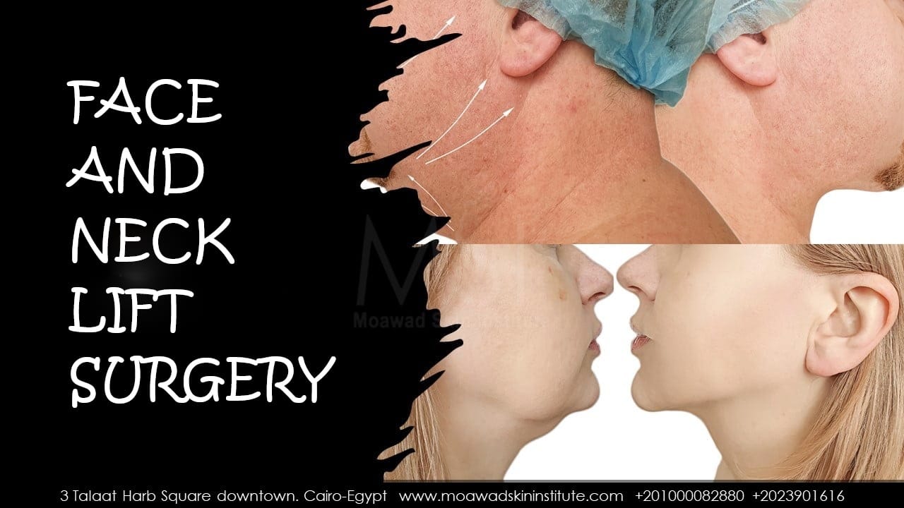 FACE AND NECK LIFT SURGERY-MALE-FEMALE