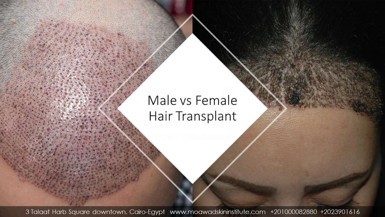 HAIR TRANSPLANT SURGERY MALE VS FEMALE