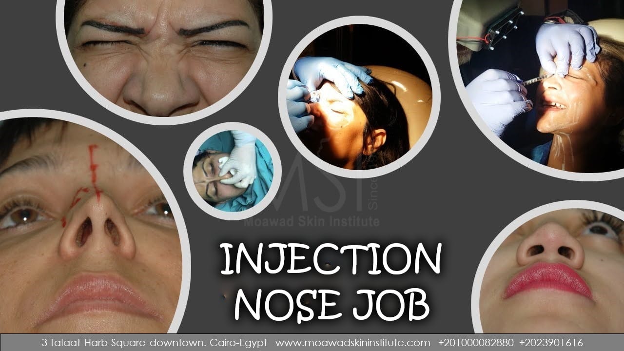 INJECTION NOSE JOB_2