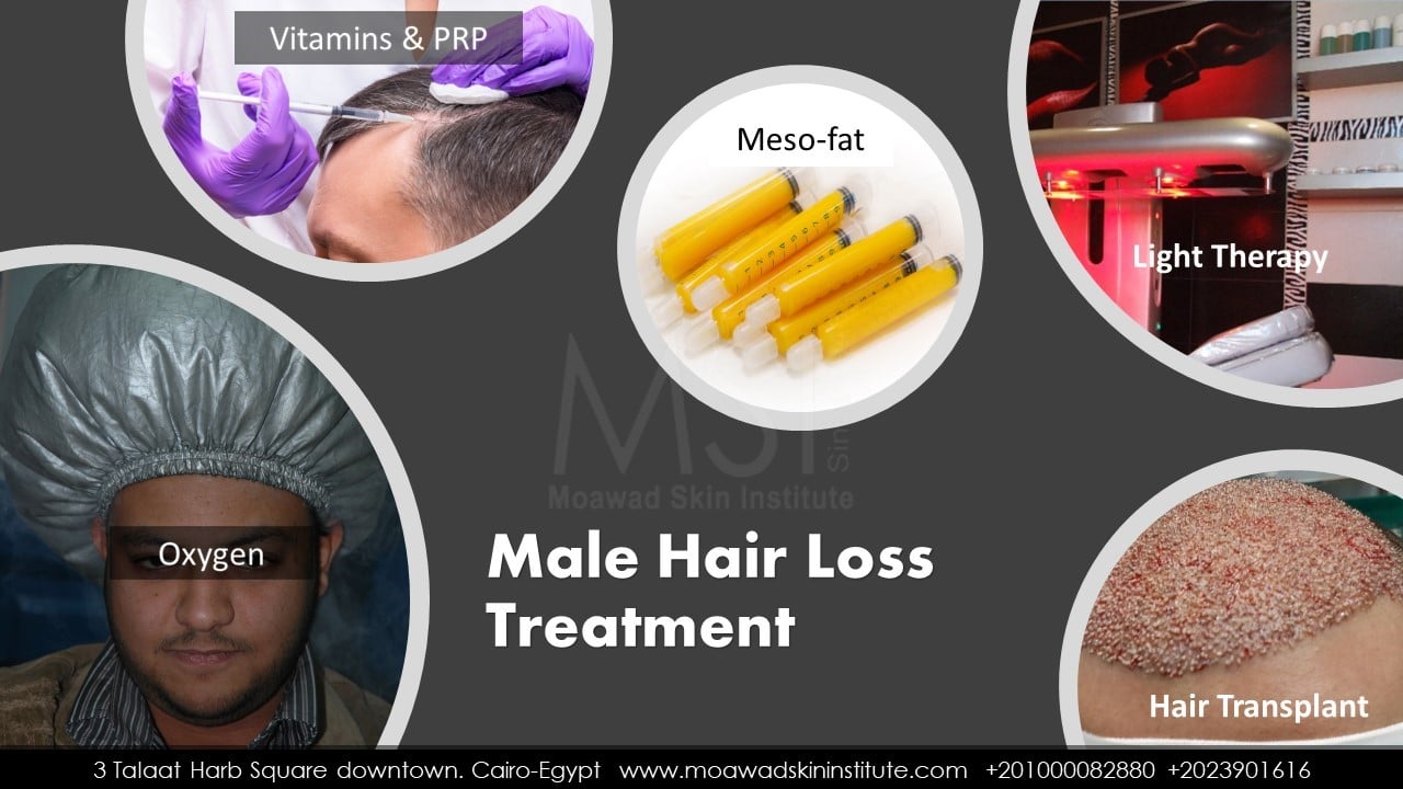 MALE HAIR LOSS TREATMENT (2)