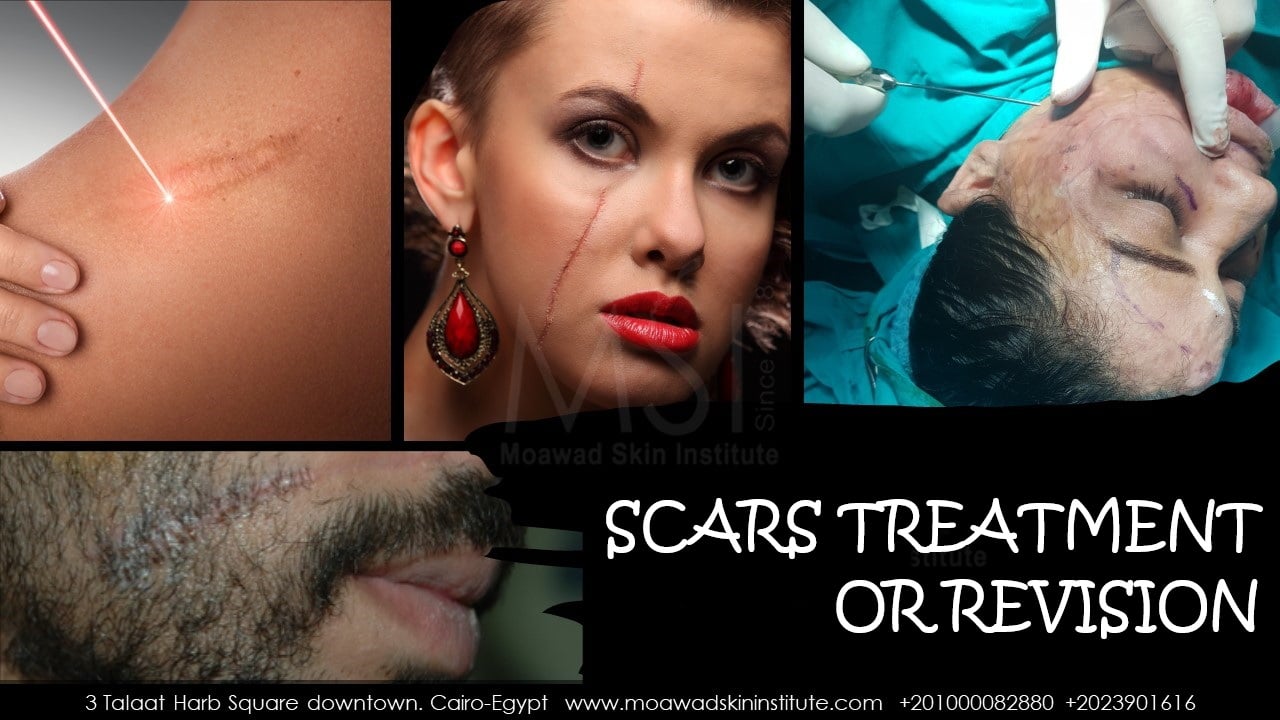 SCARS TREATMENT OR REVISION