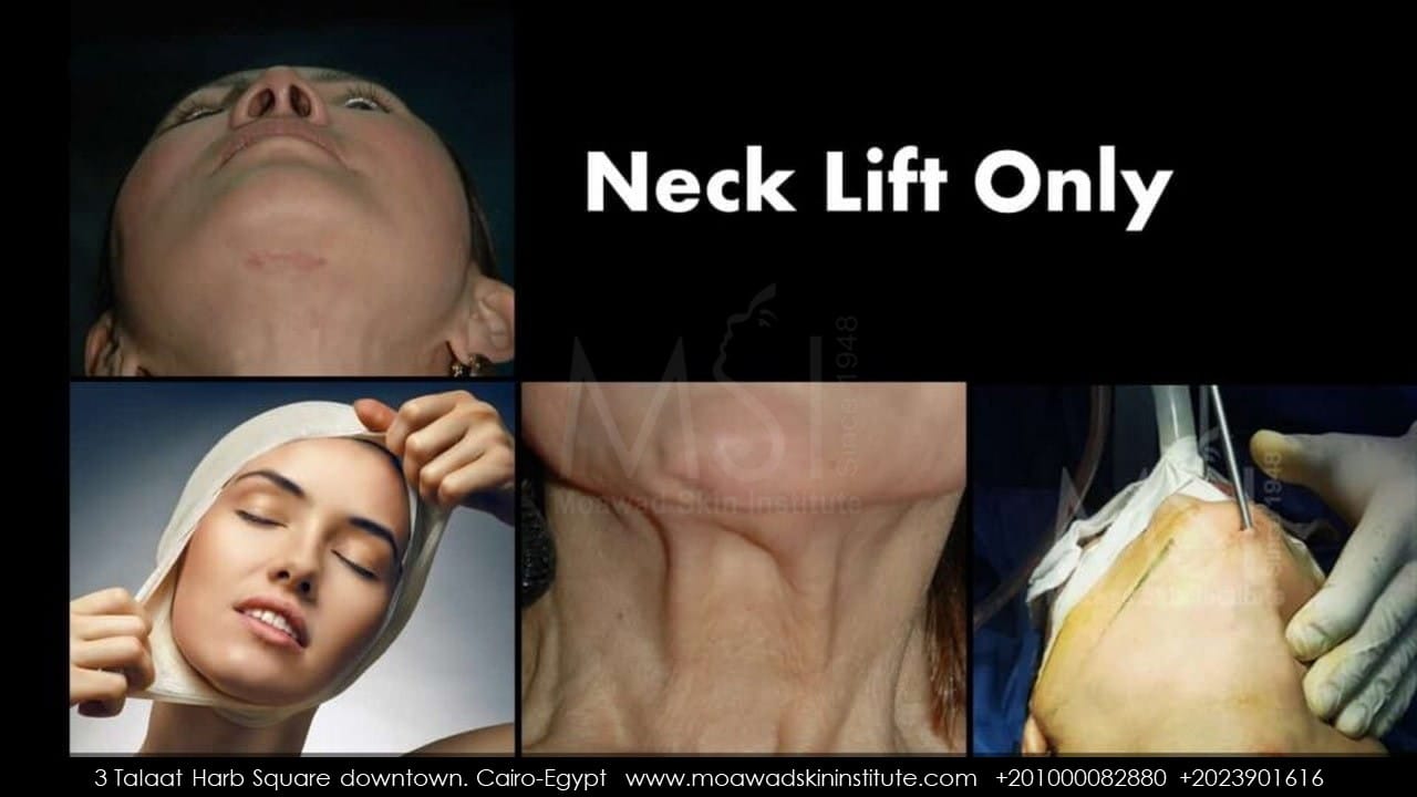 NECK LIFT ONLY