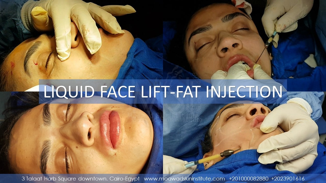 LIQUID FACE LIFT-FAT INJECTION
