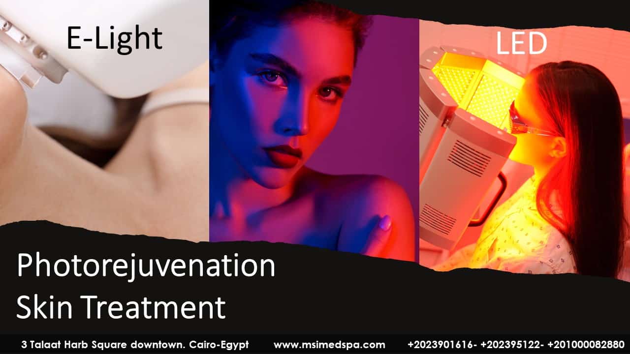 photorejuvenation skin treatment