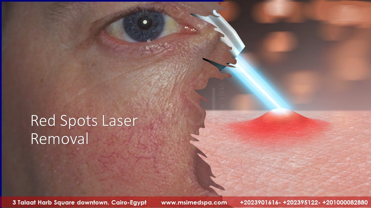 red spots laser removal